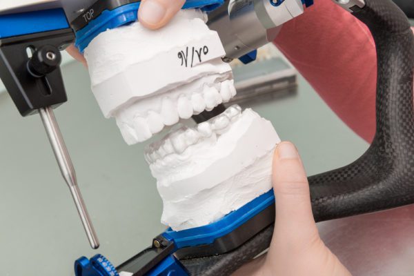 Four Benefits of 3D Printing Occlusal Splints - LuxCreo