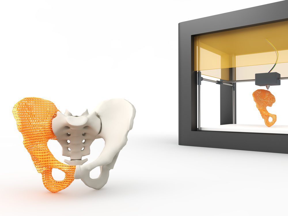 3D-printed pelvic implant