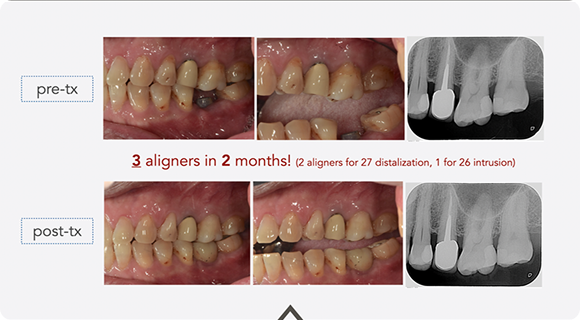 Case 2: Non-Surgical Molar Intrusion (Direct-Print Mechanics)