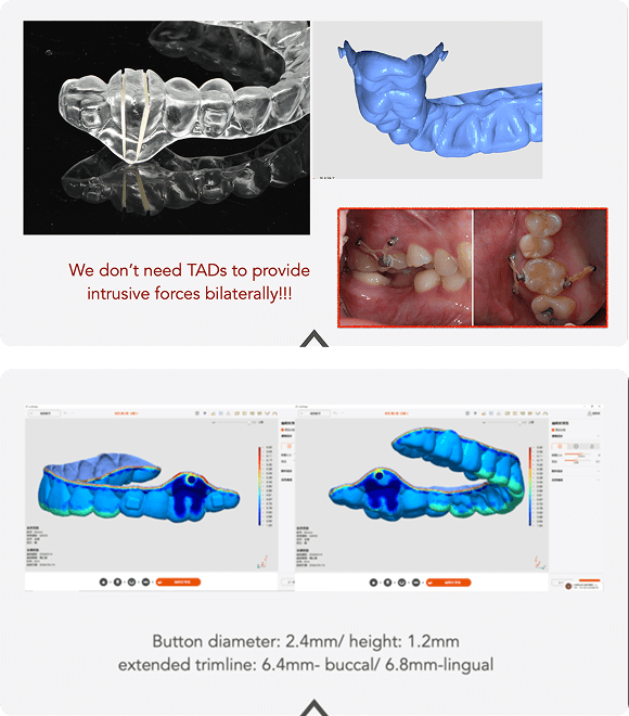 Case 2: Non-Surgical Molar Intrusion (Direct-Print Mechanics)