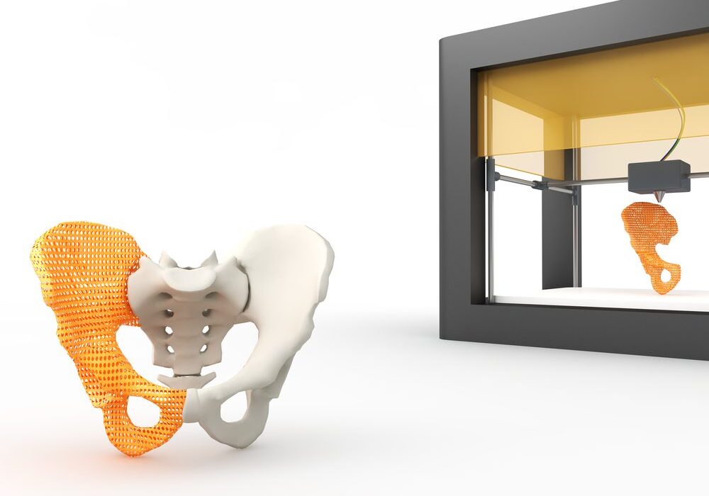 3D-printed pelvic implant